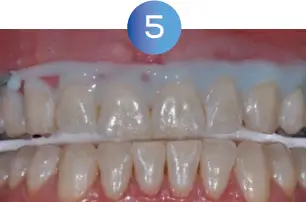 GLO Science PRO POWER+ - Indicates Technique Sensitive Step 5