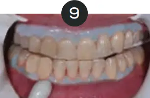 GLO Science PRO POWER+ - Indicates Technique Sensitive Step 9