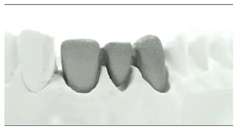 estetic-ceram-ag-0483-EMF-Bonder-1