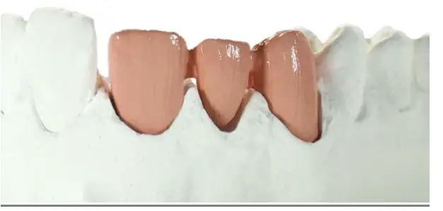 estetic-ceram-ag-0483-EMF-Bonder-2