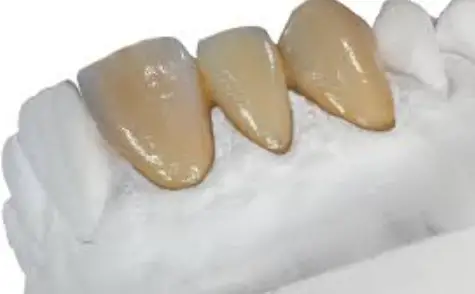 estetic-ceram-ag-0483-EMF-Bonder-product-image