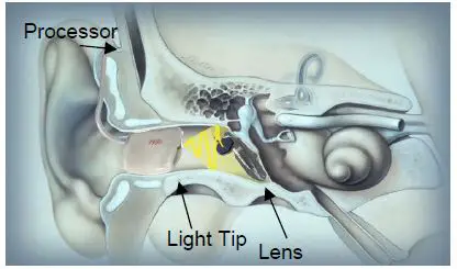 Earlens-Light-Driven-Hearing-Aid-FIG-1