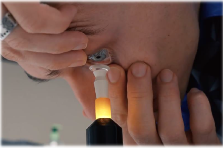 Augmented-Vision-Labs-S5-Inserter-Scleral-and-Hybrid-Lens-fig-1 (3)