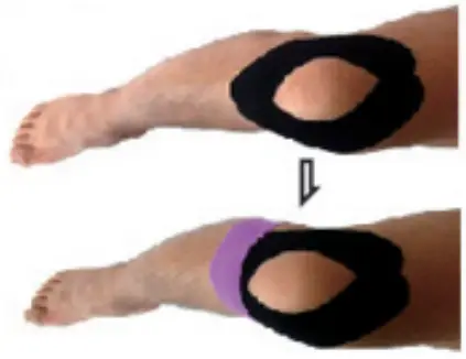 Runners/Cyclist Knee