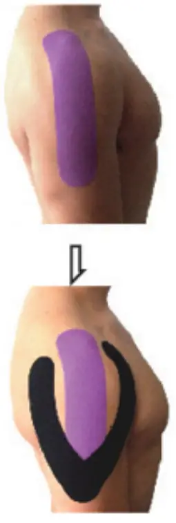 General Shoulder Pain