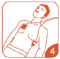 JOUSING-F7952W-J-Disposable-Self-Adhesive-Defibrillation-Pads-fig- (4)
