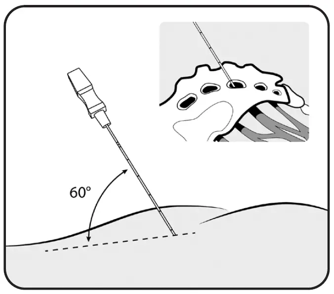 Axonics 1701 PNE Lead Implant Kit-fig-3
