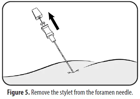Axonics 1701 PNE Lead Implant Kit-fig-6