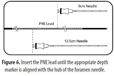 Axonics 1701 PNE Lead Implant Kit-fig-7
