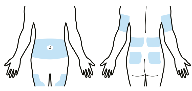 Medtronic MiniMed Mio Advance Infusion Set - fig2