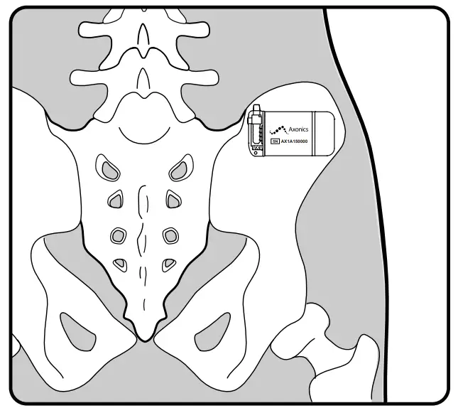 Creating the Neurostimulator Pocket