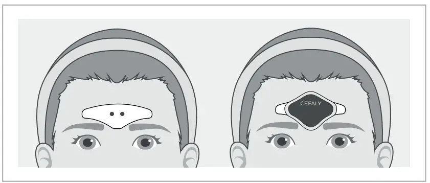 CEFALY 28031 Enhanced Migraine Treatment - attach device
