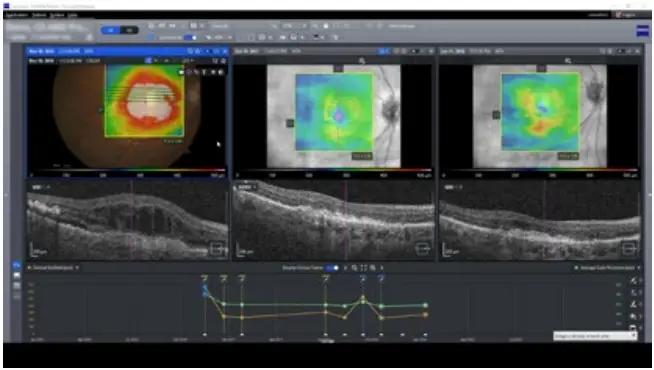 ZEISS 860 Visual Field Analyzer - ZEISS FORUM