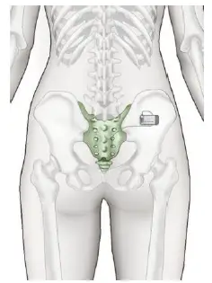 Axonics-MRI-Sacral-Neuromodulation-System-fig-5