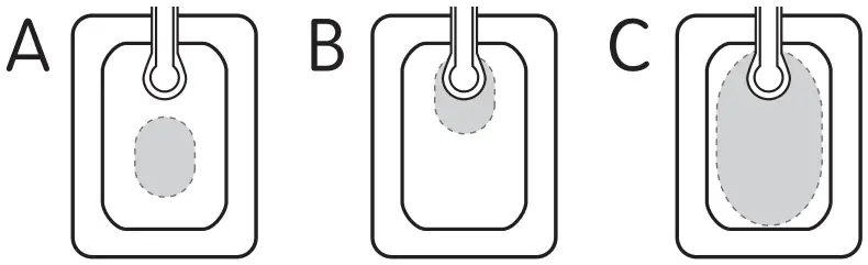 smith nephew PICO 7 Single Use Negative Pressure Wound Therapy System - Dressing change