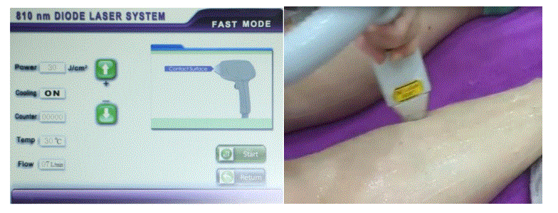 Handy-Importer-810nm-Diode-Laser-Hair-Removal-Device-fig-11