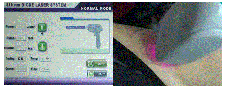 Handy-Importer-810nm-Diode-Laser-Hair-Removal-Device-fig-13