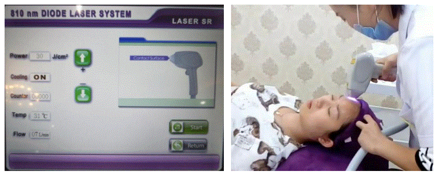 Handy-Importer-810nm-Diode-Laser-Hair-Removal-Device-fig-16