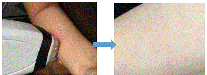 Handy-Importer-810nm-Diode-Laser-Hair-Removal-Device-fig-22