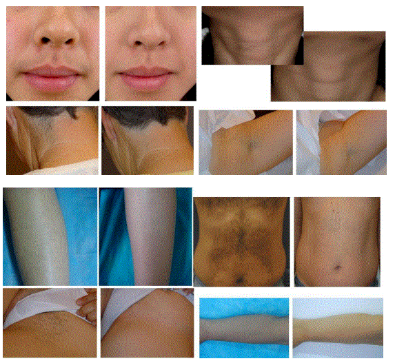 Handy-Importer-810nm-Diode-Laser-Hair-Removal-Device-fig-23