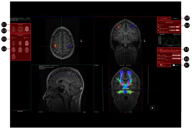 NordicNeuroLab nordicBrainEx Clinical Neuroimaging Software for Functional MRI - fig 1