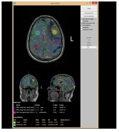 NordicNeuroLab nordicBrainEx Clinical Neuroimaging Software for Functional MRI - fig 2