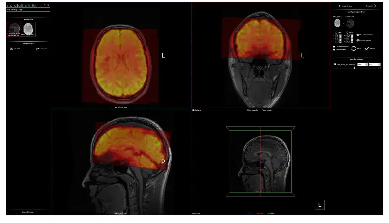 NordicNeuroLab nordicBrainEx Clinical Neuroimaging Software for Functional MRI - fig