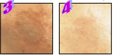 Avance Beauty IPL350-PRJ E-Light Flux Professional IPL Photo-Rejuvenation System - Age Spots