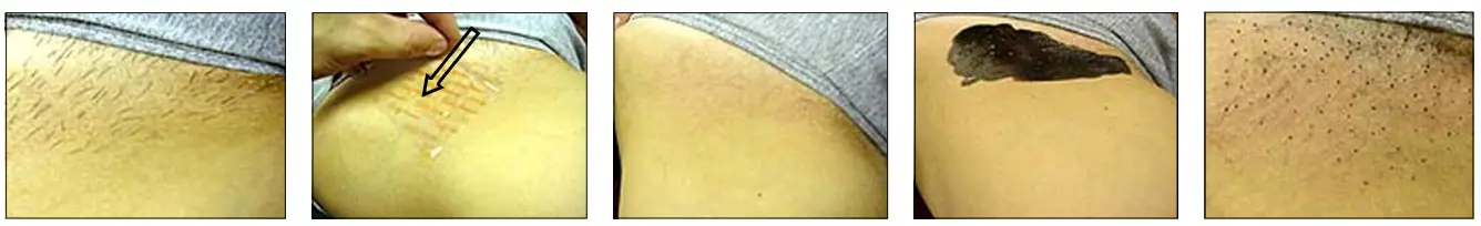 Avance Beauty IPL350-PRJ E-Light Flux Professional IPL Photo-Rejuvenation System - Carbon Dye