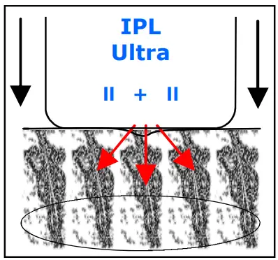 Avance Beauty IPL350-PRJ E-Light Flux Professional IPL Photo-Rejuvenation System - Pulsed Light1