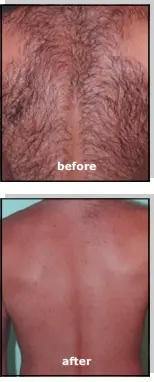 Avance Beauty IPL350-PRJ E-Light Flux Professional IPL Photo-Rejuvenation System - Treatment Efficacy