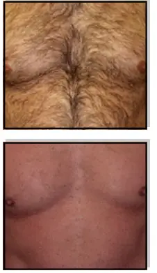 Avance Beauty IPL350-PRJ E-Light Flux Professional IPL Photo-Rejuvenation System - Pre-Qualifications