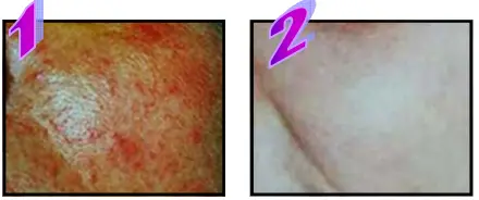 Avance Beauty IPL350-PRJ E-Light Flux Professional IPL Photo-Rejuvenation System - Rosacea