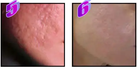 Avance Beauty IPL350-PRJ E-Light Flux Professional IPL Photo-Rejuvenation System - Scars