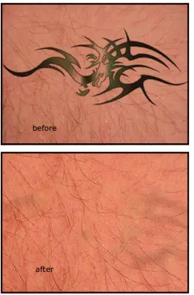 Avance Beauty IPL350-PRJ E-Light Flux Professional IPL Photo-Rejuvenation System - Treatment Efficacy