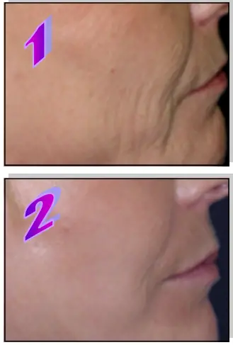 Avance Beauty IPL350-PRJ E-Light Flux Professional IPL Photo-Rejuvenation System - Wrinkle