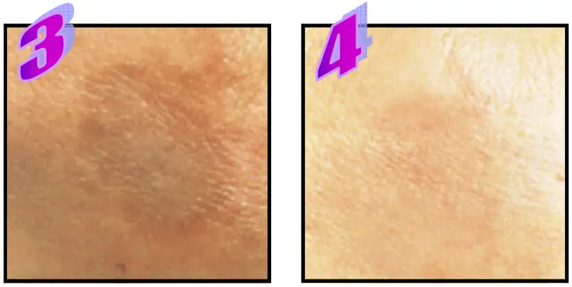 Avance Beauty IPL350 WRK E Light Flux Professional IPL Wrinkle Reduction System - Age Spots