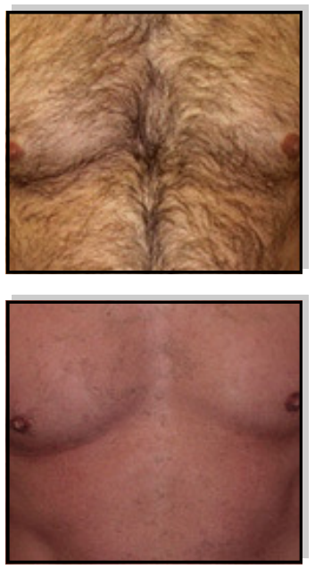 Avance Beauty IPL350 WRK E Light Flux Professional IPL Wrinkle Reduction System - Client Pre-Qualifications