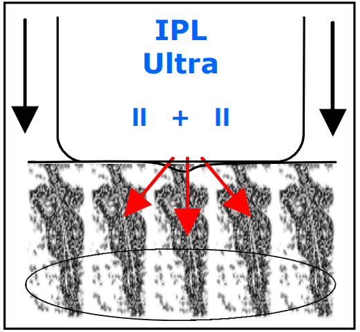 Avance Beauty IPL350 WRK E Light Flux Professional IPL Wrinkle Reduction System - Client Reaction