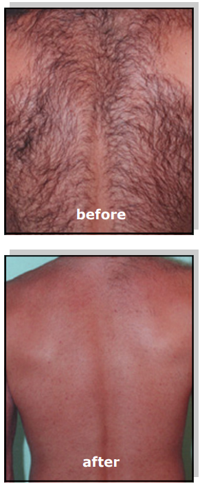 Avance Beauty IPL350 WRK E Light Flux Professional IPL Wrinkle Reduction System - Hair Removal Treatment