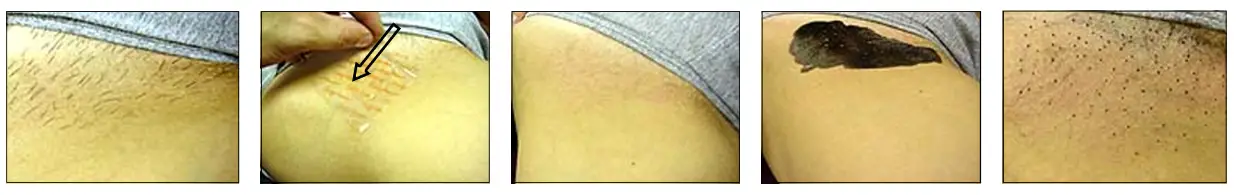 Avance Beauty IPL350 WRK E Light Flux Professional IPL Wrinkle Reduction System - Hair Removal