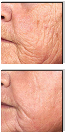 Avance Beauty IPL350 WRK E Light Flux Professional IPL Wrinkle Reduction System - Photo-Rejuvenation