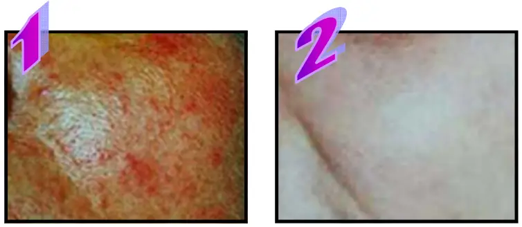 Avance Beauty IPL350 WRK E Light Flux Professional IPL Wrinkle Reduction System - Rosacea