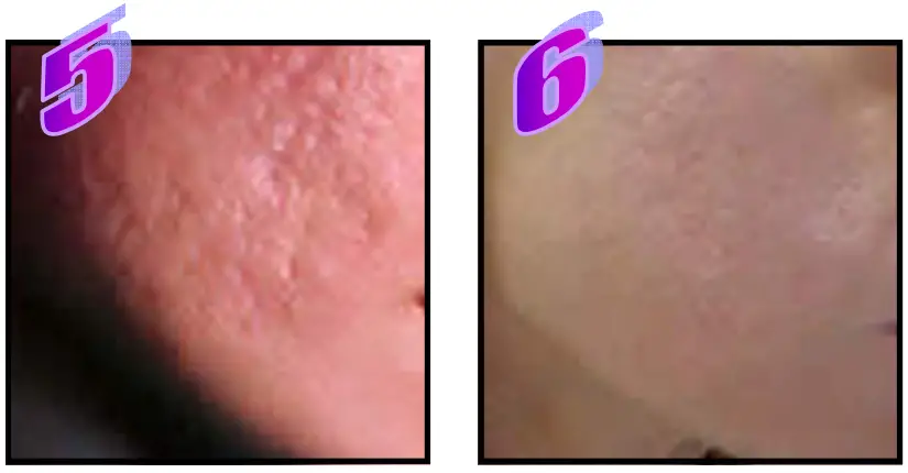 Avance Beauty IPL350 WRK E Light Flux Professional IPL Wrinkle Reduction System - Scars