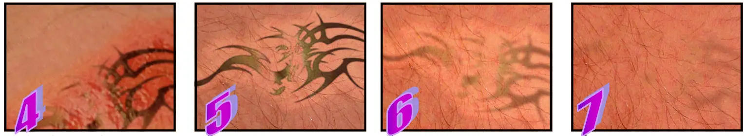 Avance Beauty IPL350 WRK E Light Flux Professional IPL Wrinkle Reduction System - Treatment Procedure 1