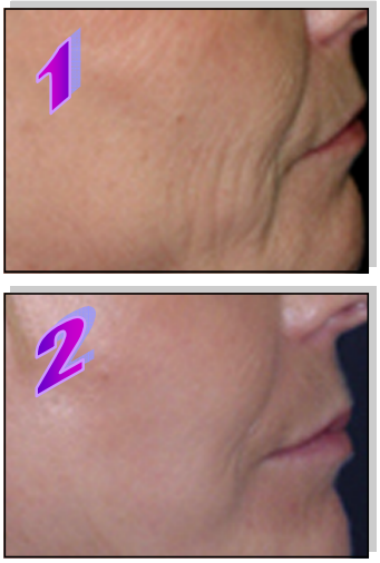 Avance Beauty IPL350 WRK E Light Flux Professional IPL Wrinkle Reduction System - Treatment Procedure 2