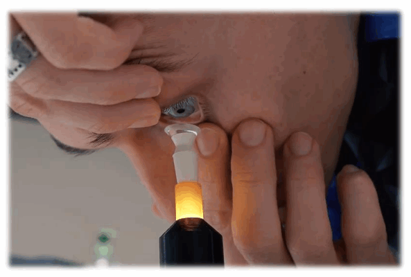 AUGMENTED VISION LABS S5 Mini Hybrid Lens Insertion System - LENS