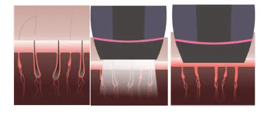 LUMENESSA-LS101-IPL-Hair-Removal-Device-FIG- (1)