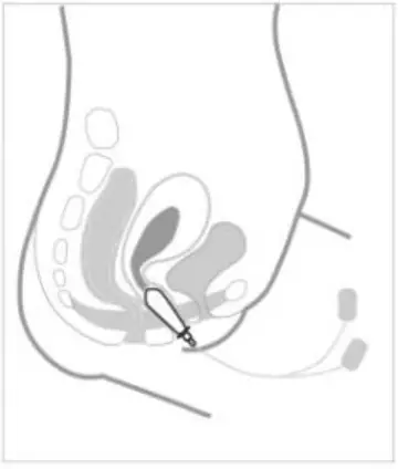 TensCare-X-VPK-Kegel-Trainer-Vaginal-Probe-FIG-2