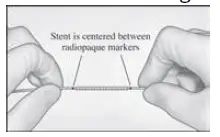 GETInGE-iCast-Covered-Stent-System-2
